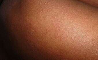 Bułgaria: Epidemia odry. Przyczyną brak szczepień