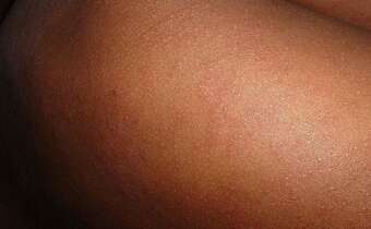 WHO: Mamy światową epidemię odry