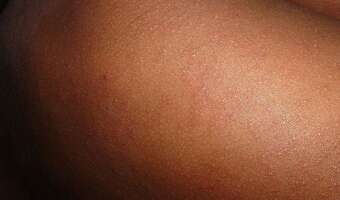 Włochy zmagają się z odrą