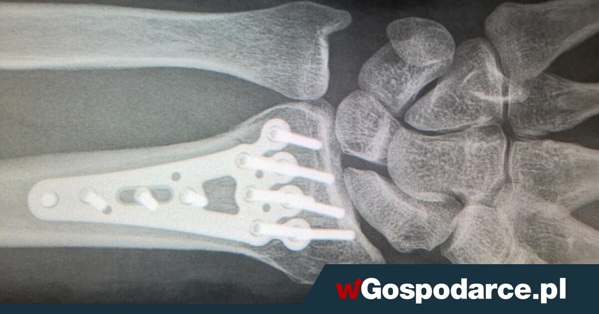 Sezon złamań trwa w najlepsze