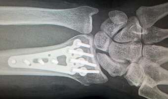 Sezon złamań trwa w najlepsze