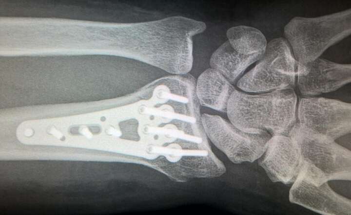 Złamane kości przedramienia na zdjęciu rentgenowskim. ZDJĘCIE ILUSTRACYJNE / autor: Pixabay