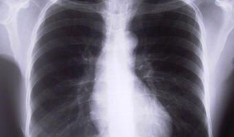 Skutecznie wyhodowano sztuczne płuca