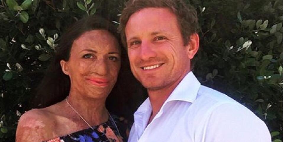 fot.Facebook/Turia Pitt