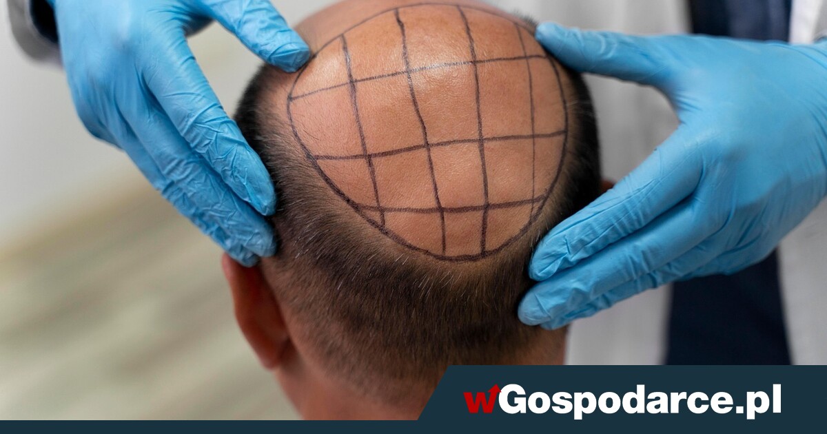 Przeszczep włosów. "Tutaj zapłacę 5 tys. zł, w Polsce zapłaciłbym 30 tys. zł"