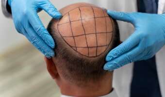 Przeszczep włosów. "Tutaj zapłacę 5 tys. zł, w Polsce zapłaciłbym 30 tys. zł"