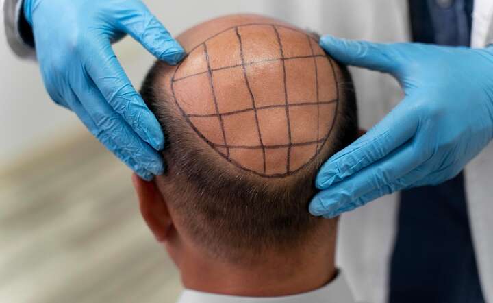 Ładne włosy to nie tylko kwestia estetyki. Ale co po nieudanym zabiegu? / autor: Pixabay