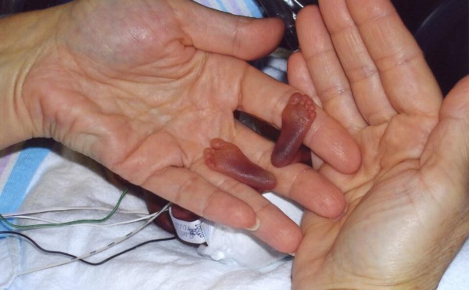 fot. Amilia - najmłodszy wcześniak świata, urodzona w UK 22 tygodniu życia. Prawo dopuszcza tam aborcję do 24 tygodnia / facebook